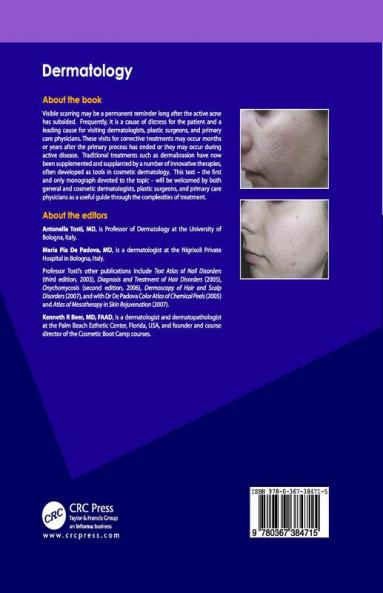 Acne Scars
