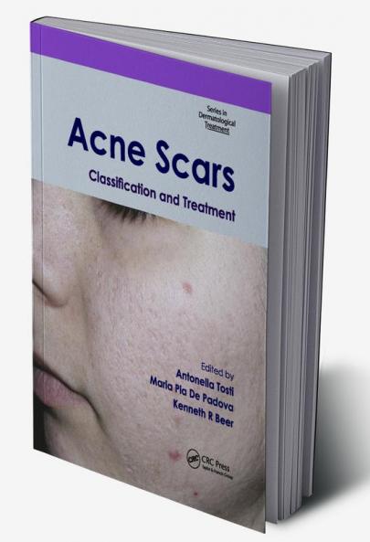 Acne Scars