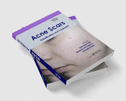 Acne Scars