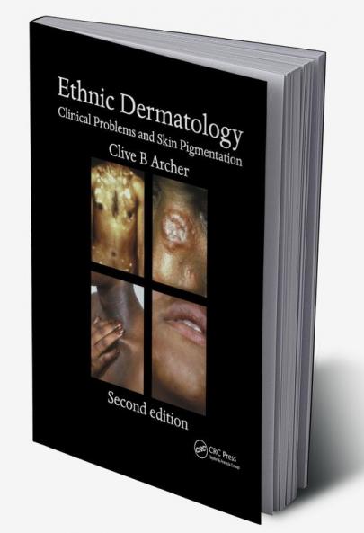 Ethnic Dermatology