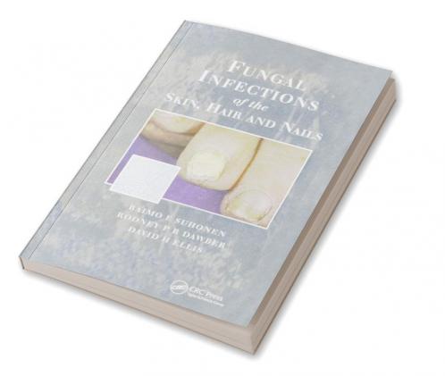 Fungal Infections of the Skin and Nails