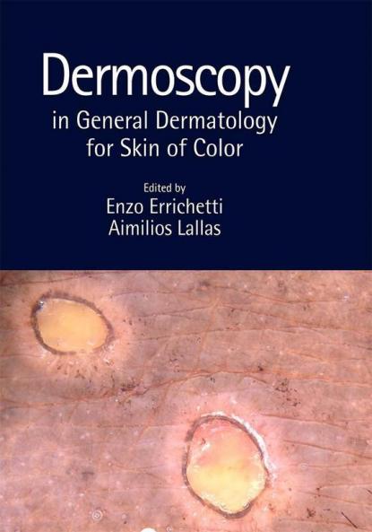 Dermoscopy in General Dermatology for Skin of Color