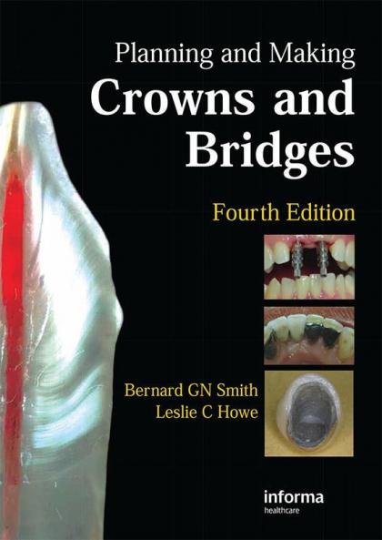 Planning and Making Crowns and Bridges