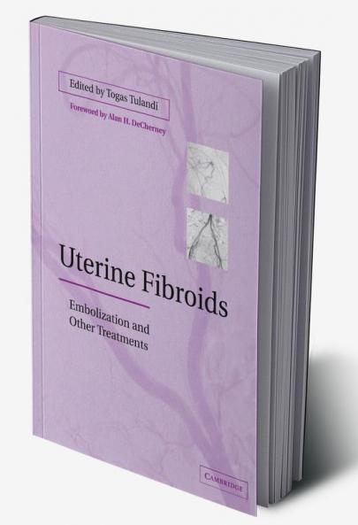 Uterine Fibroids