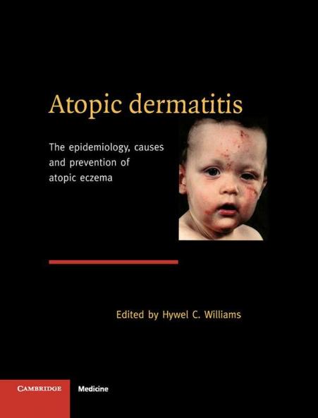 Atopic Dermatitis