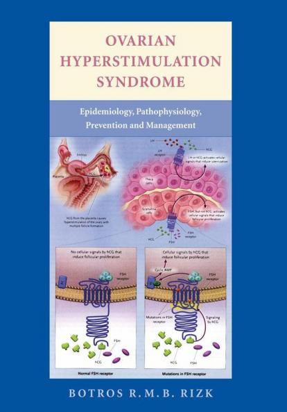 Ovarian Hyperstimulation Syndrome