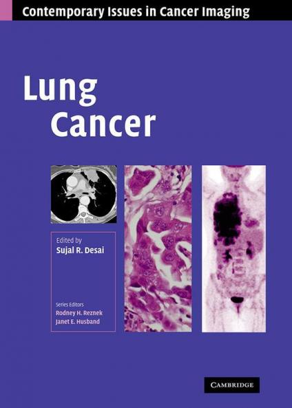 Lung Cancer