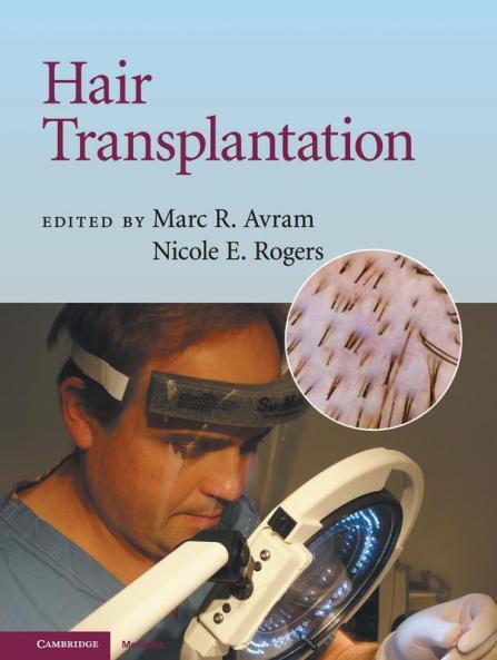 Hair Transplantation