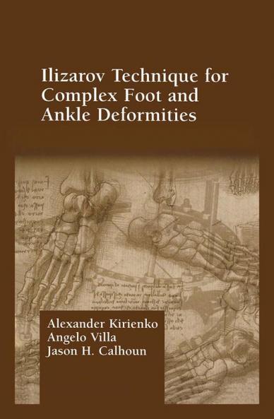 Ilizarov Technique for Complex Foot and Ankle Deformities