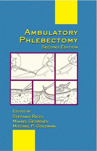 Ambulatory Phlebectomy