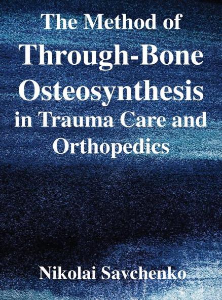 Method of Through-Bone Osteosynthesis in Trauma Care and Orthopedics