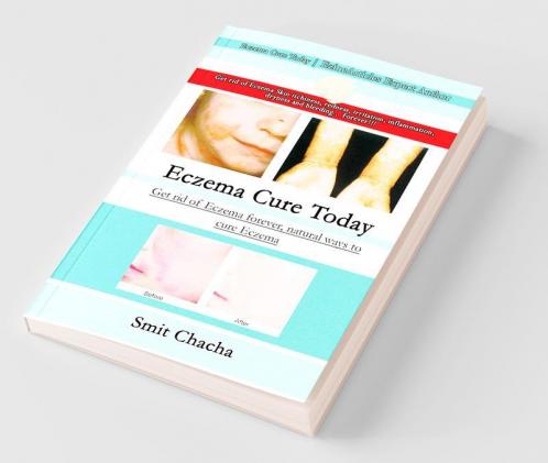 Eczema Cure Today - Get rid of Eczema forever natural ways to cure Eczema