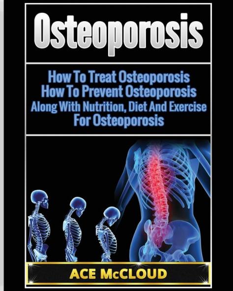 Osteoporosis: How To Treat Osteoporosis: How To Prevent Osteoporosis: Along With Nutrition Diet And Exercise For Osteoporosis (Reverse or Prevent Bone Loss from Osteoporosis All)