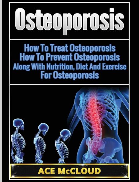 Osteoporosis: How To Treat Osteoporosis: How To Prevent Osteoporosis: Along With Nutrition Diet And Exercise For Osteoporosis (Reverse or Prevent Bone Loss from Osteoporosis All)