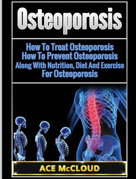 Osteoporosis: How To Treat Osteoporosis: How To Prevent Osteoporosis: Along With Nutrition Diet And Exercise For Osteoporosis (Reverse or Prevent Bone Loss from Osteoporosis All)