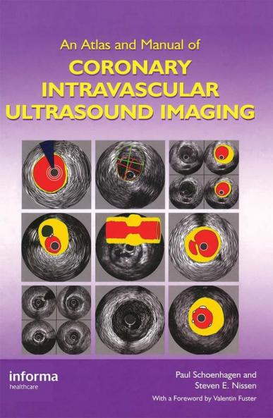 Atlas and Manual of Coronary Intravascular Ultrasound Imaging