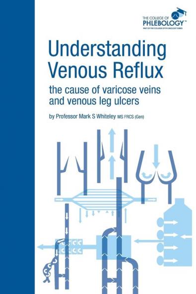 Understanding Venous Reflux the Cause of Varicose Veins and Venous Leg Ulcers (College of Phlebology)