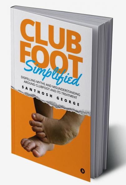 Clubfoot Simplified : Dispelling Myths and Misunderstanding around Clubfoot and its treatment
