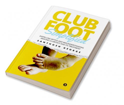 Clubfoot Simplified : Dispelling Myths and Misunderstanding around Clubfoot and its treatment