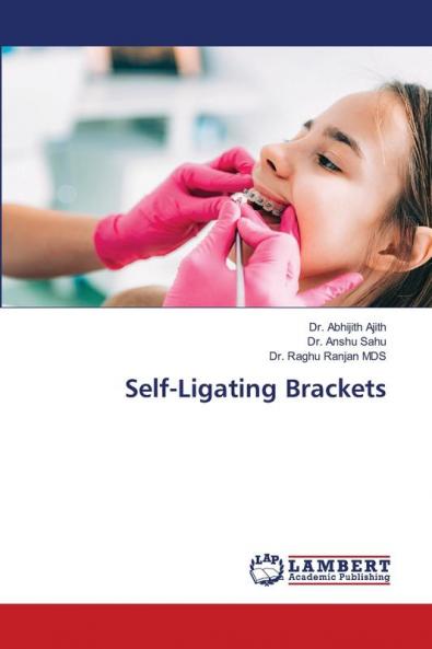 Self-Ligating Brackets