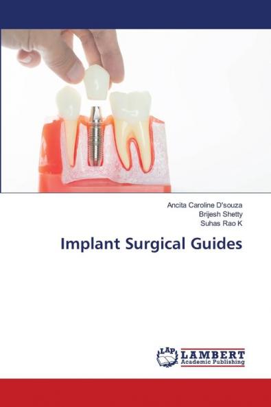 Implant Surgical Guides