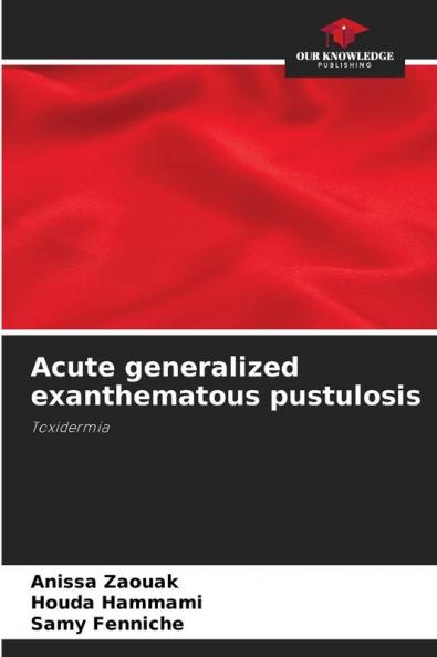 Acute generalized exanthematous pustulosis