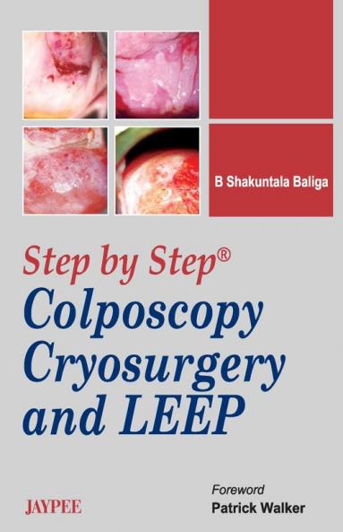STEP BY STEP COLPOSCOPY CRYOSURGERY AND LEEP WITH DVD-ROM