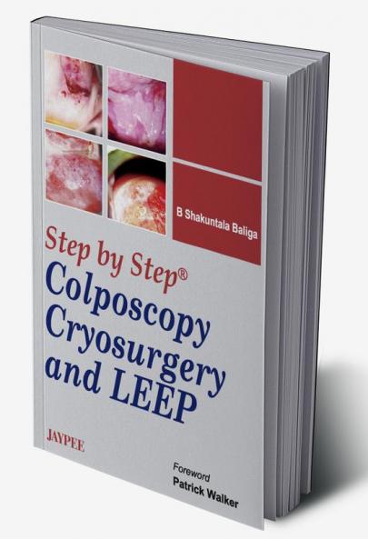 STEP BY STEP COLPOSCOPY CRYOSURGERY AND LEEP WITH DVD-ROM