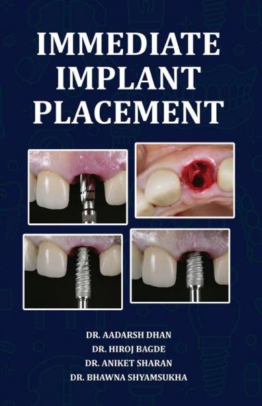 Immediate Implant Placement