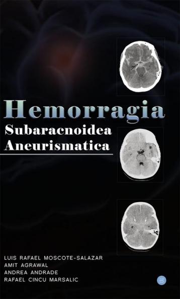 Hemorragia Subaracnoidea Aneurismatica