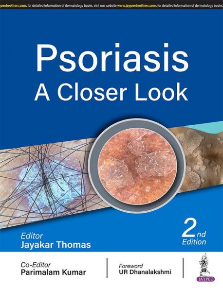 PSORIASIS: A CLOSER LOOK
