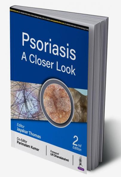 PSORIASIS: A CLOSER LOOK