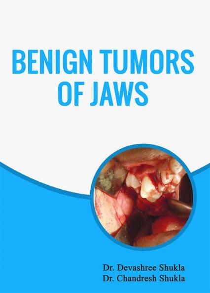 BENIGN TUMORS OF JAWS