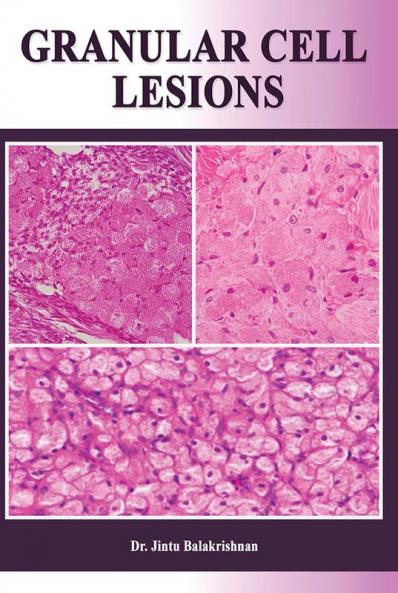 Granular Cell Lesions