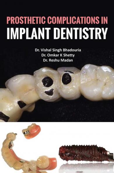Prosthetic Complications In Implant Dentistry