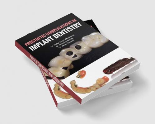 Prosthetic Complications In Implant Dentistry