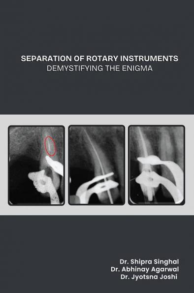 Separation of Rotary Instruments Demystifying The Enigma