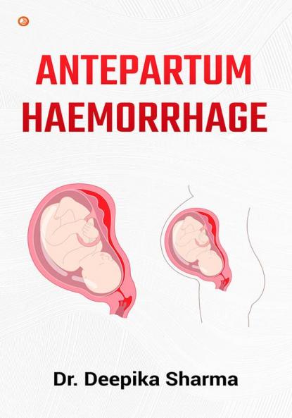 Antepartum Haemorrhage