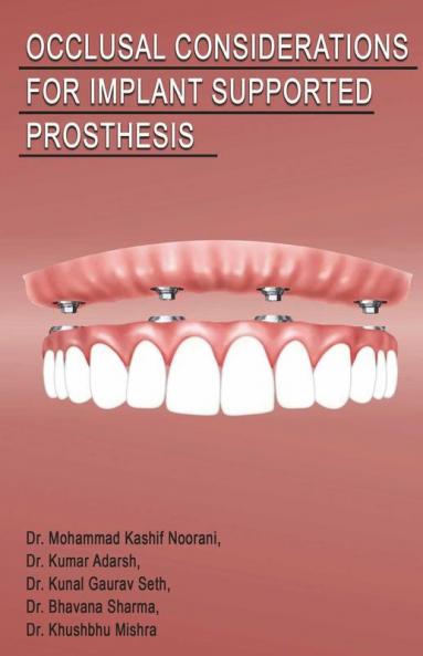 Occlusal Considerations For Implant Supported Prosthesis