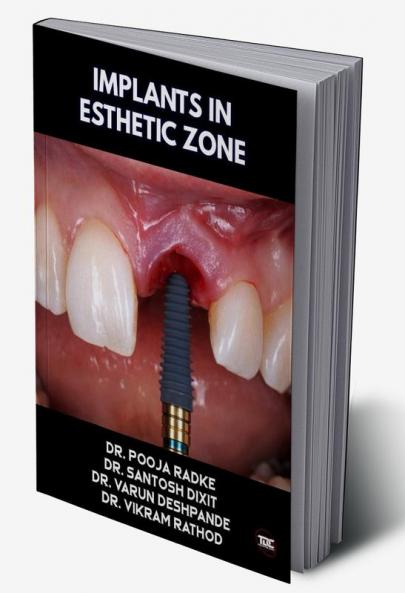 IMPLANTS IN ESTHETIC ZONE