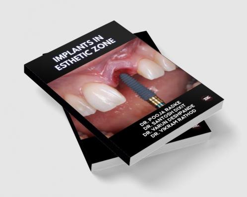 IMPLANTS IN ESTHETIC ZONE