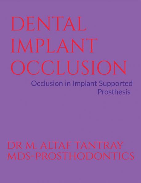 DENTAL IMPLANT OCCLUSION : OCCLUSION IN IMPLANT SUPPORTED PROSTHESIS