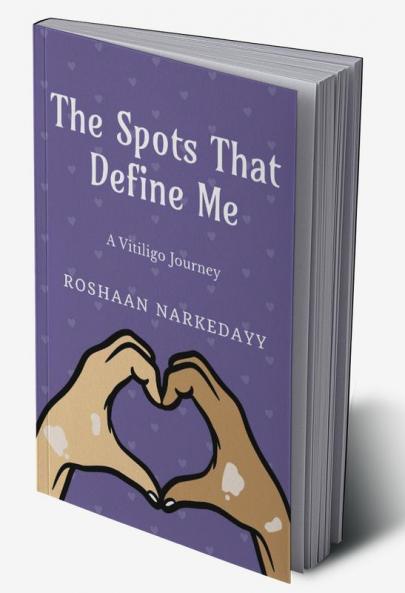 The Spots That Define Me : A Vitiligo Journey