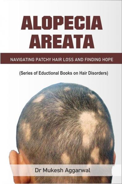 ALOPECIA AREATA