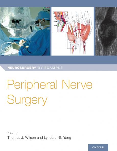 Peripheral Nerve Surgery