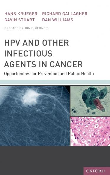 Hpv and Other Infectious Agents in Cancer