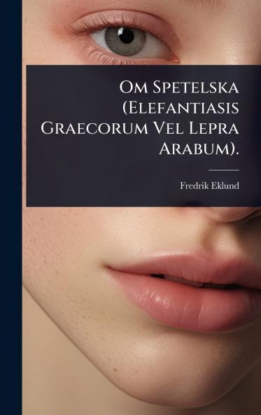 Om Spetelska (Elefantiasis Graecorum Vel Lepra Arabum).