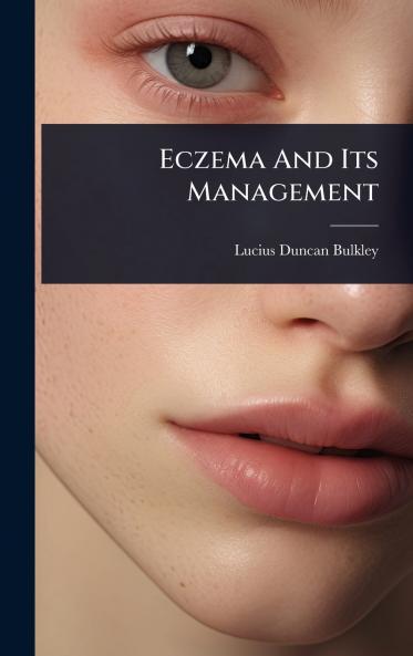 Eczema And Its Management