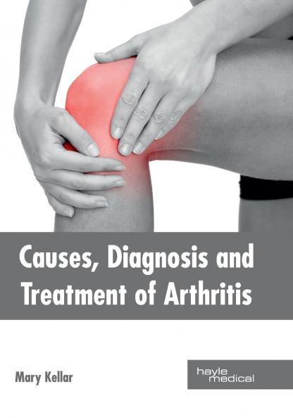 Causes Diagnosis and Treatment of Arthritis