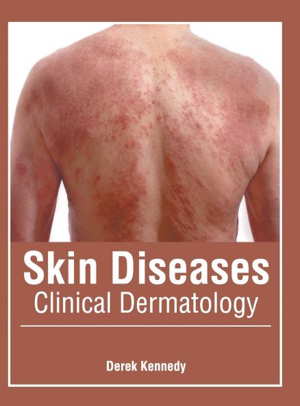 Skin Diseases